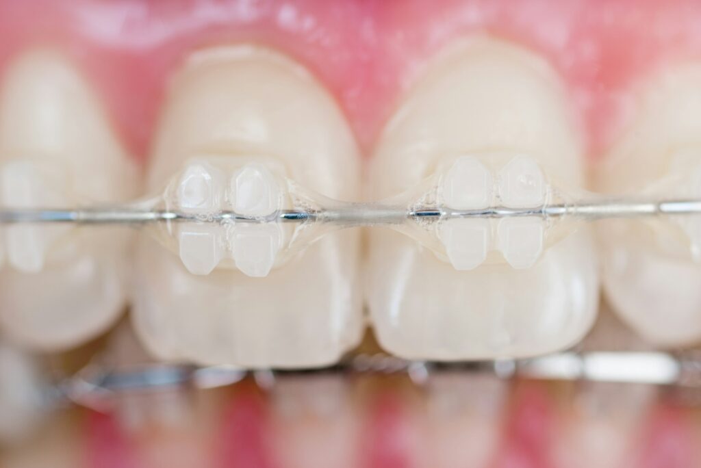 Super macro shot of teeth with braces